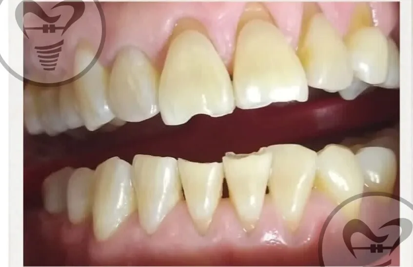 Dentadura desgastada y despareja antes del tratamiento