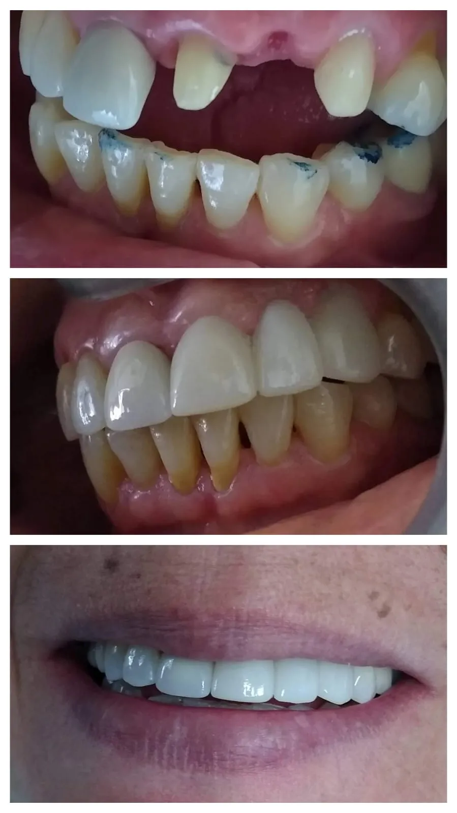 Secuencia de tres fotografías de una rehabilitación dental completa