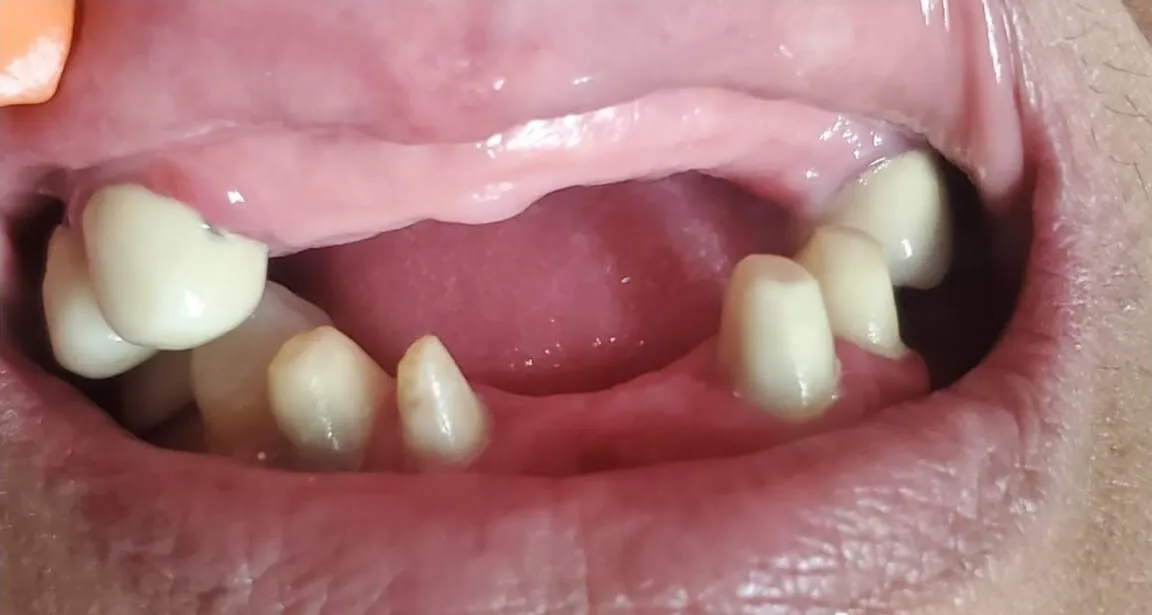 Maxilar superior con varias piezas ausentes, antes del tratamiento